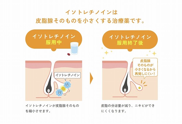 ニキビ治療の内服薬「イソトレチノイン」とは？