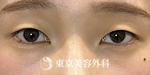 埋没3点留めの症例写真（ビフォー）