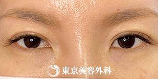 東京美容外科の二重切開（アフター）