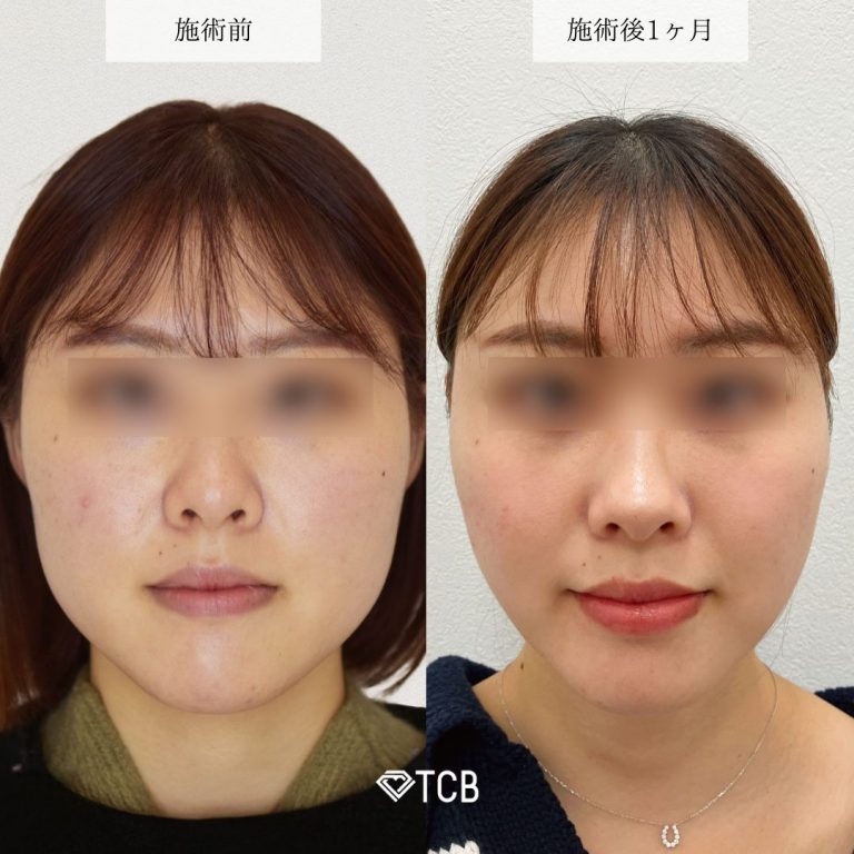 TCBボトックス症例写真