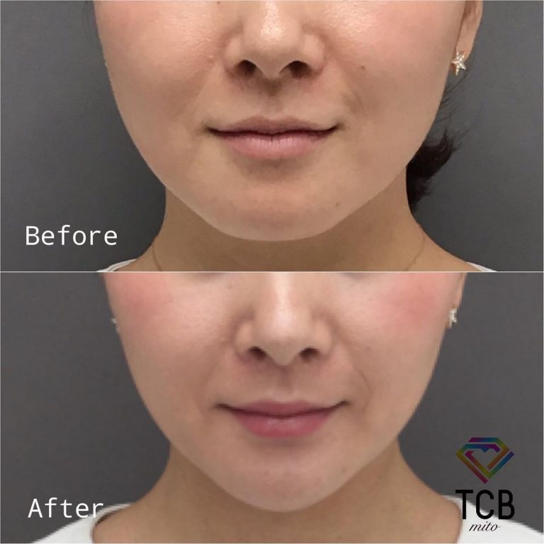 TCBハイフ症例写真