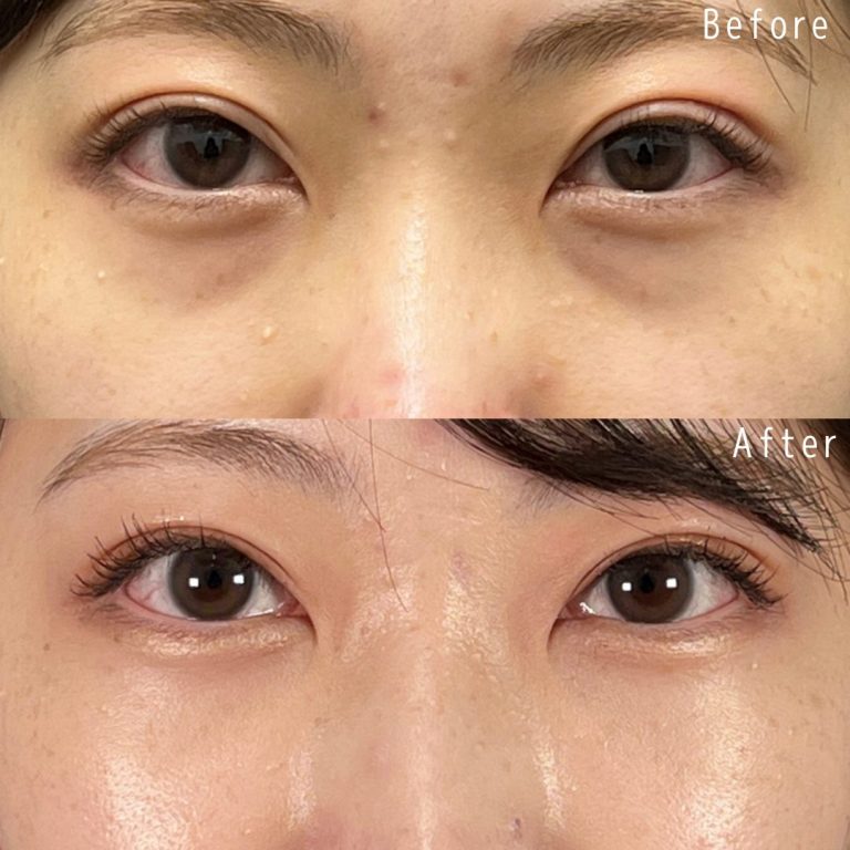 TCBクマ取り症例写真