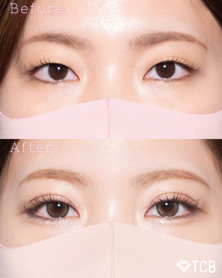 TCB二重埋没法の症例写真