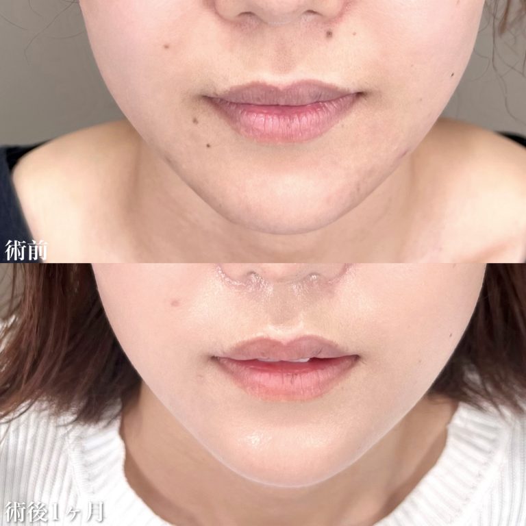 TCBほくろ除去症例写真