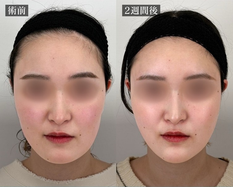 TCB糸リフト症例写真