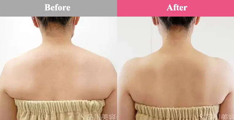 品川美容外科肩ボトックス