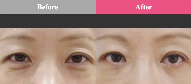 品川美容外科プチシワ取り