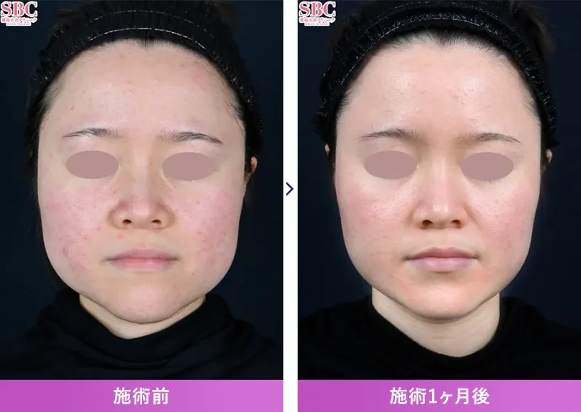 湘南美容クリニックエラボトックス症例写真