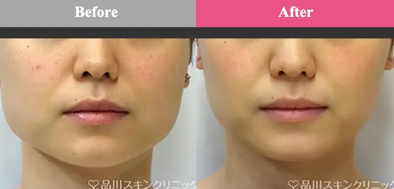 品川美容外科エラボトックス