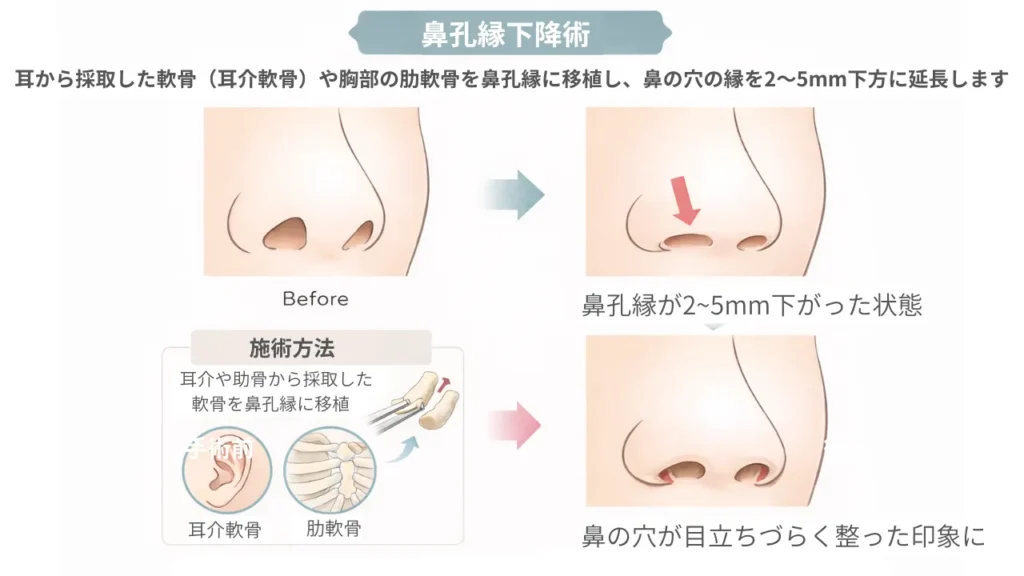 鼻孔縁下降術の説明