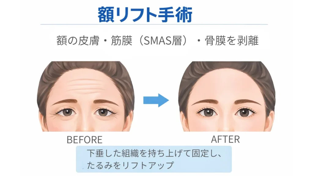 額リフト手術